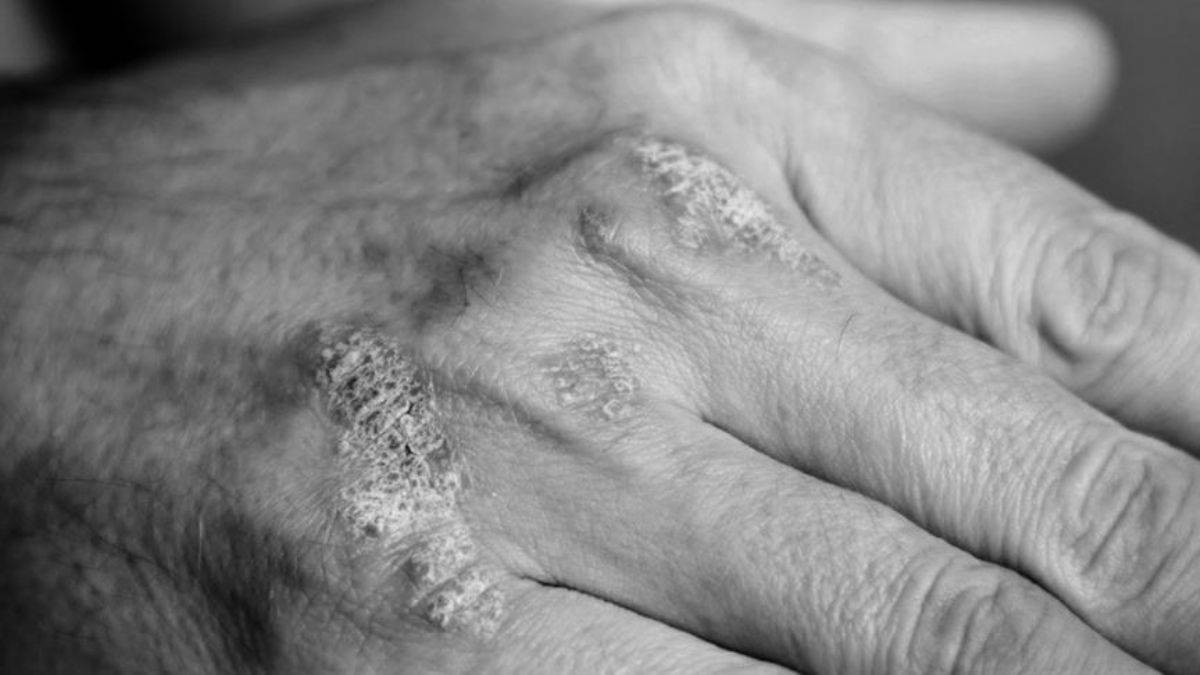 Soğuk havalarda artış gösteren egzamaya karşı öneriler