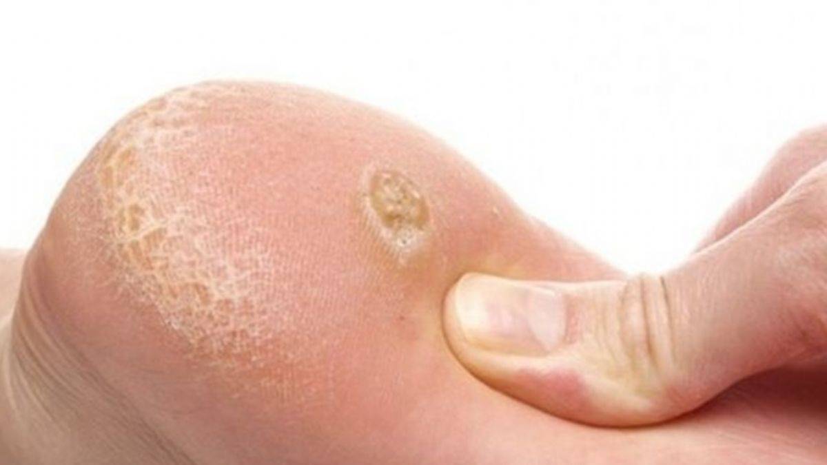 Ayaklarımızda neden nasır oluşuyor?