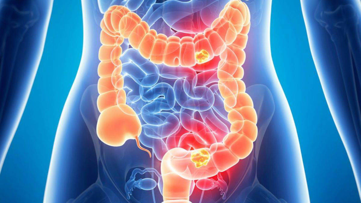 Bağırsak kanserinin erkeklerde daha sık görülmesinin nedenleri