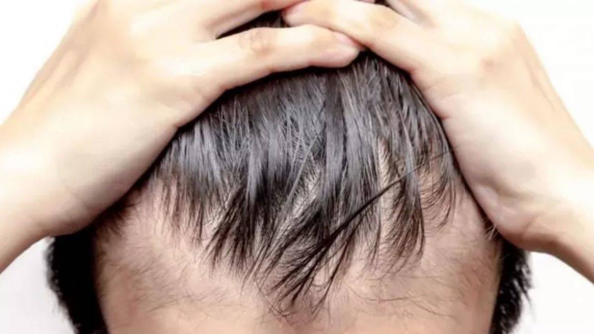 Saç dökülmesi tedavi edilebilir mi?
