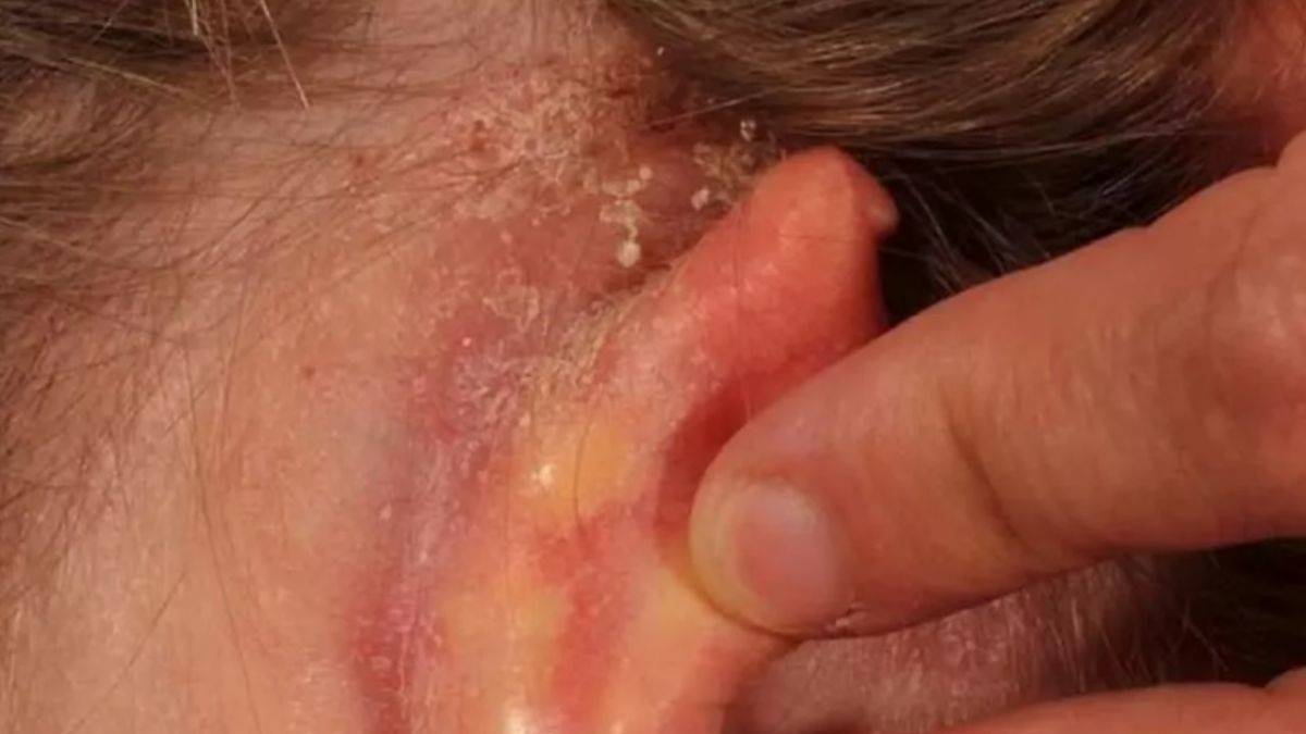 Kulak arkası egzamasını geçirmek için...