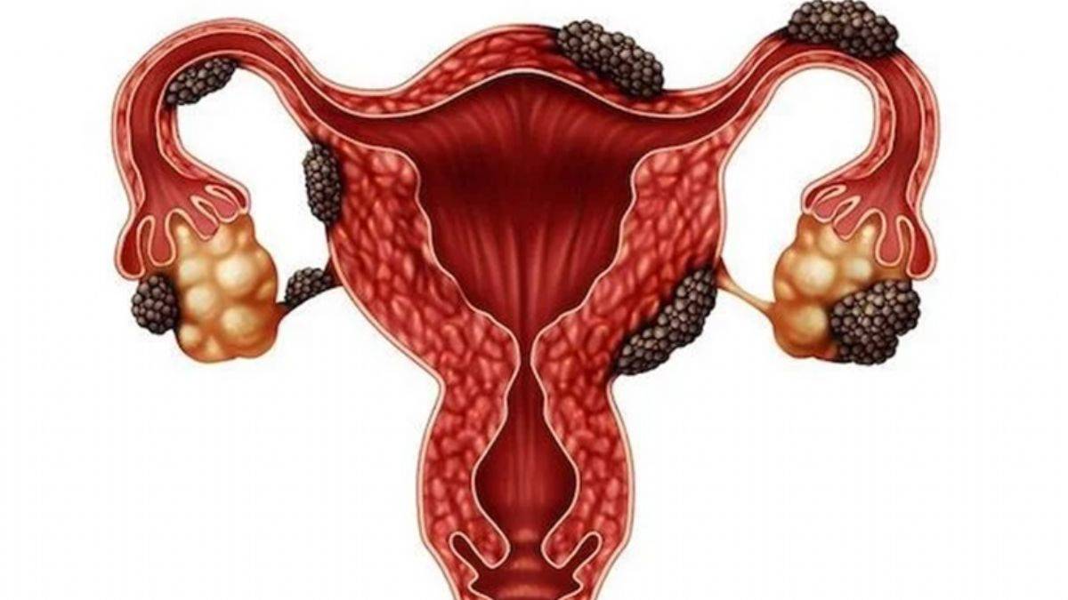 Çikolata kisti nasıl anlaşılır?