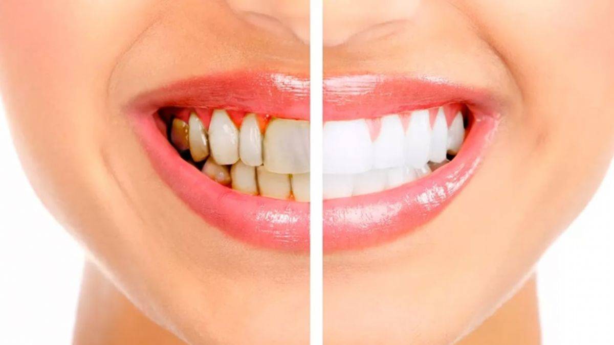 Diş taşlarını evde temizlemek istiyorsanız...