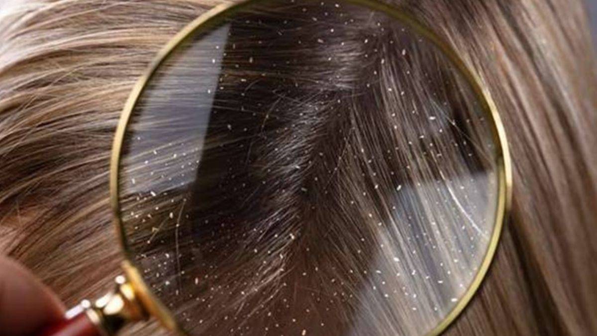 Omega 3 eksikliği yüzünden kepek sorunu yaşıyor olabilirsiniz