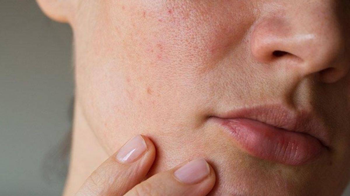 Cilt lekeleriniz varsa bu maskeleri yapın!