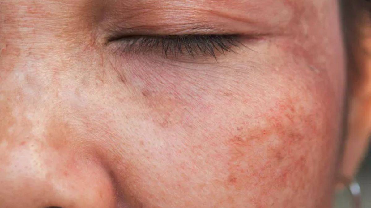 Cilt lekelerinden kurtulmak için...