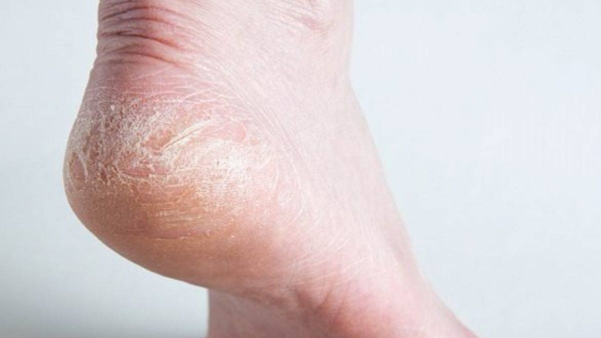 Ayaklarınız kuruyor ve topuklarınız çatlıyorsa...