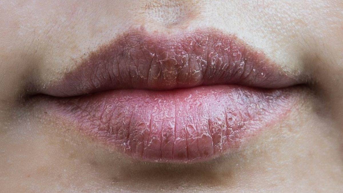 Çatlak dudaklar için doğal dudak balmı nasıl hazırlanır?