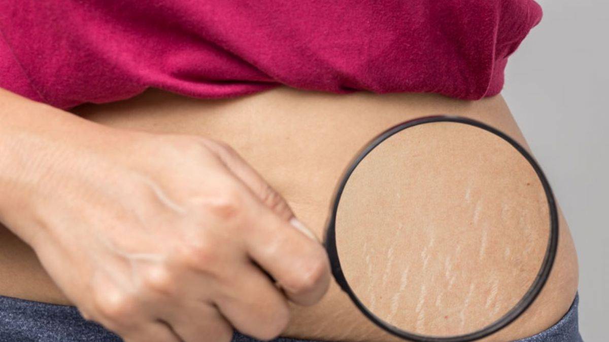 Vücut çatlaklarından kurtulmak için...