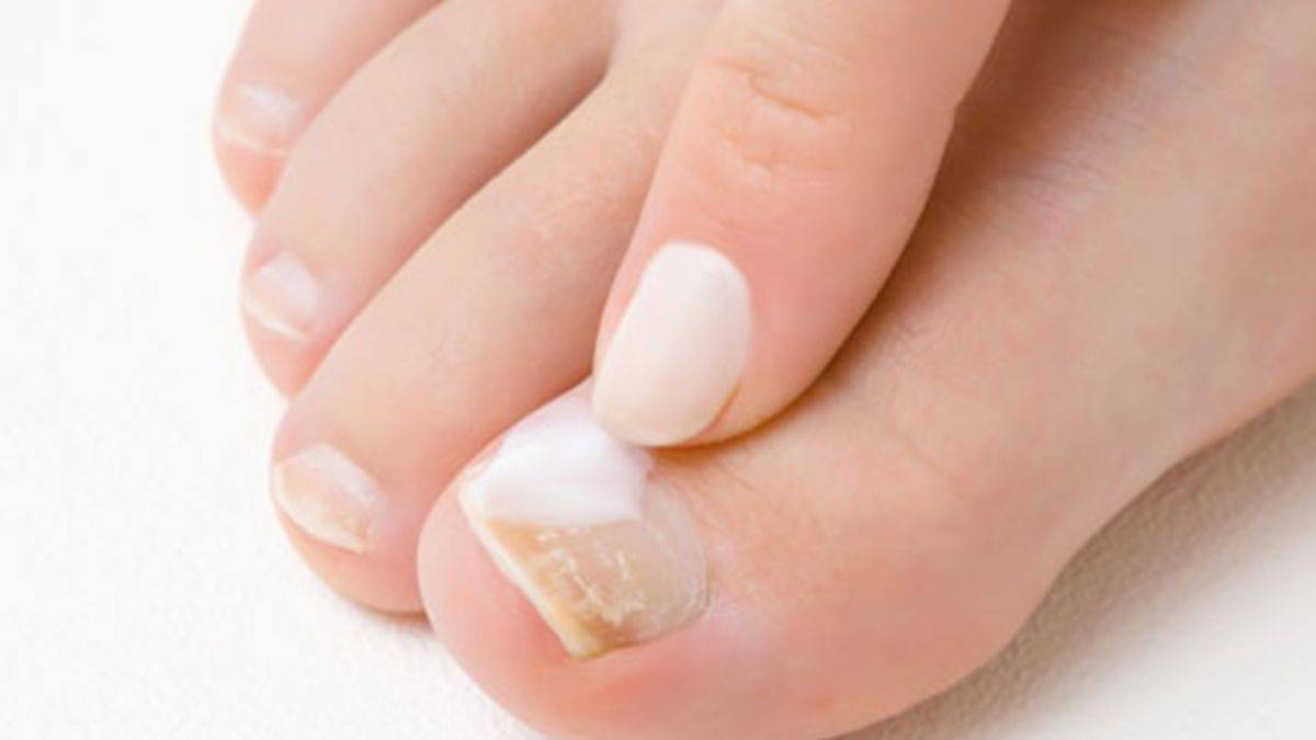 Tırnak mantarının geçmesi için ilginç yöntem!