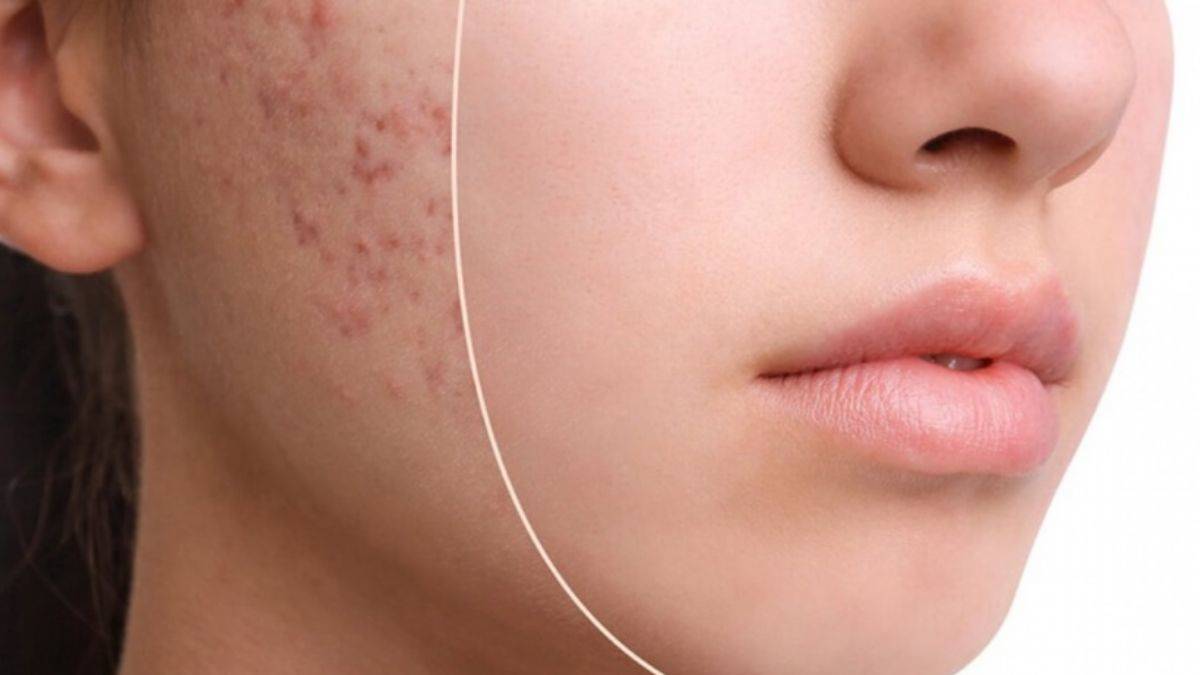 Sivilceli cilde sahipseniz kekik toniği kullanın!