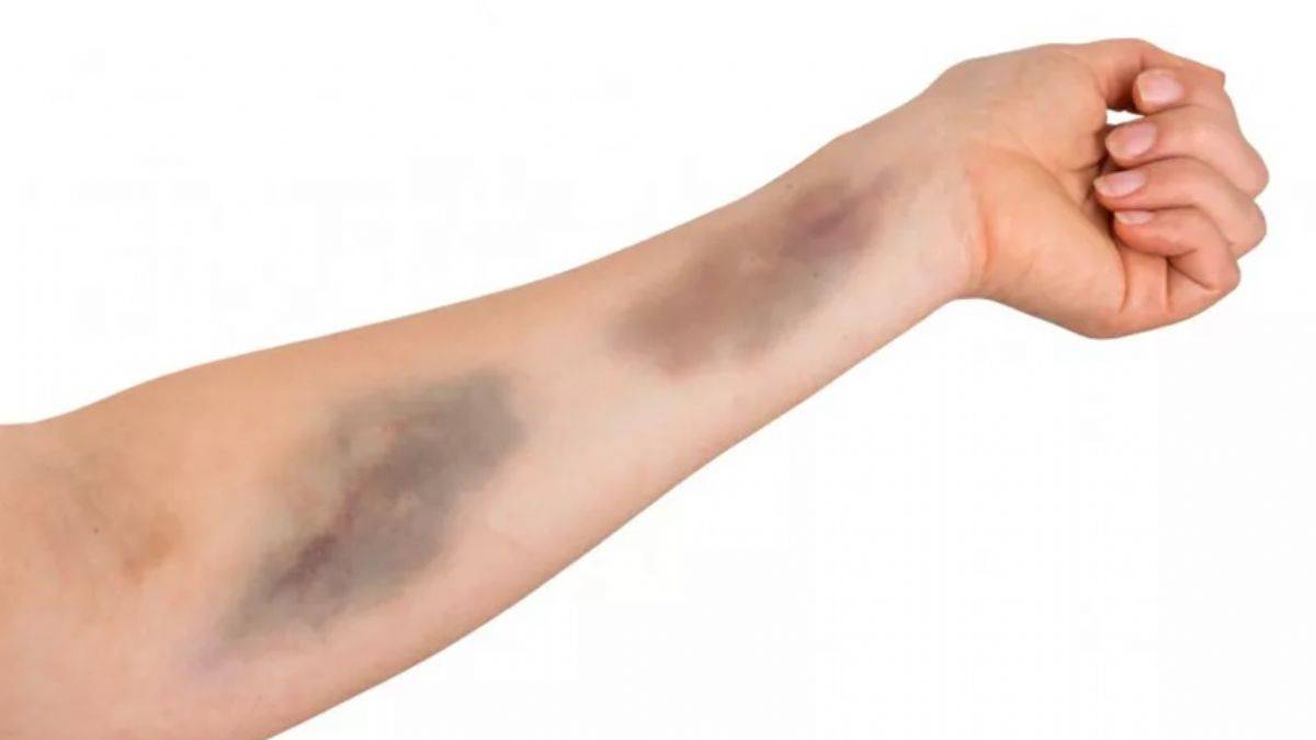 Cildinizdeki morluğu geçirmek için...