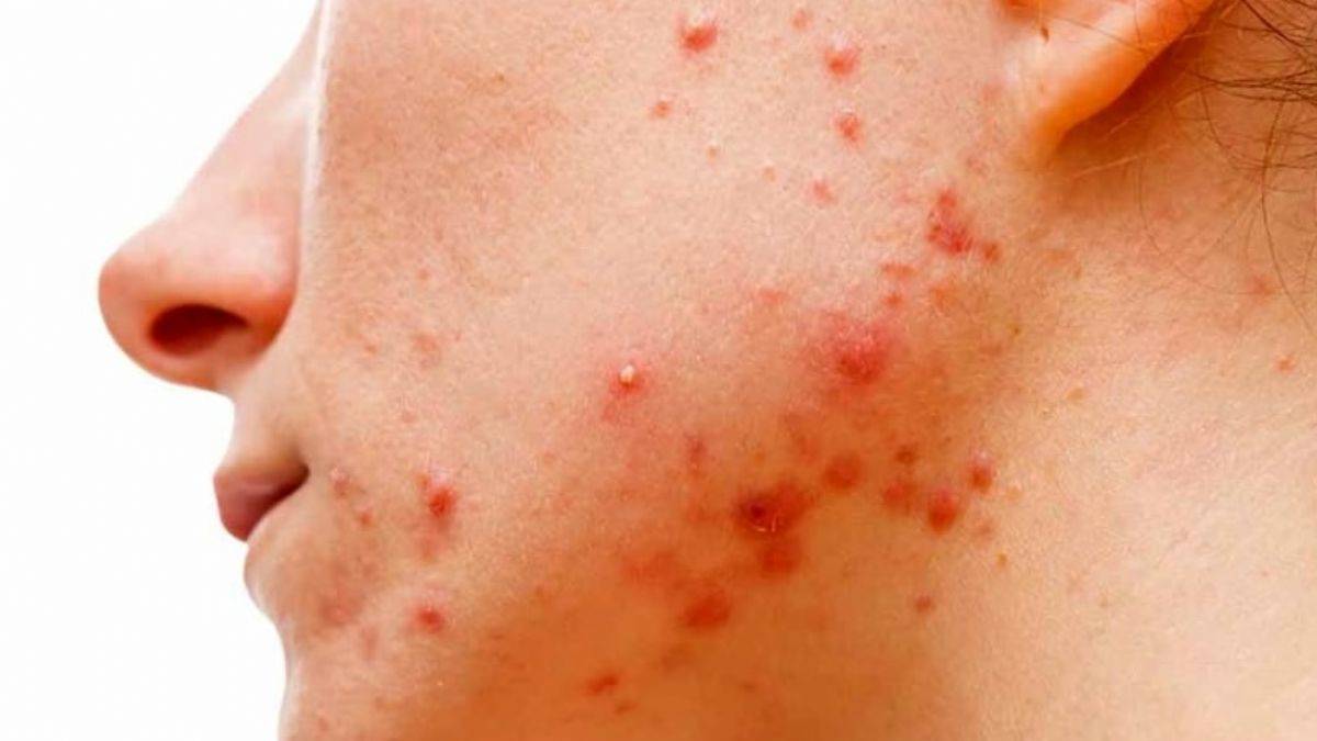 Prof. Dr. Saraçoğlu'ndan sivilceleri gideren sirkeli kür tarifi