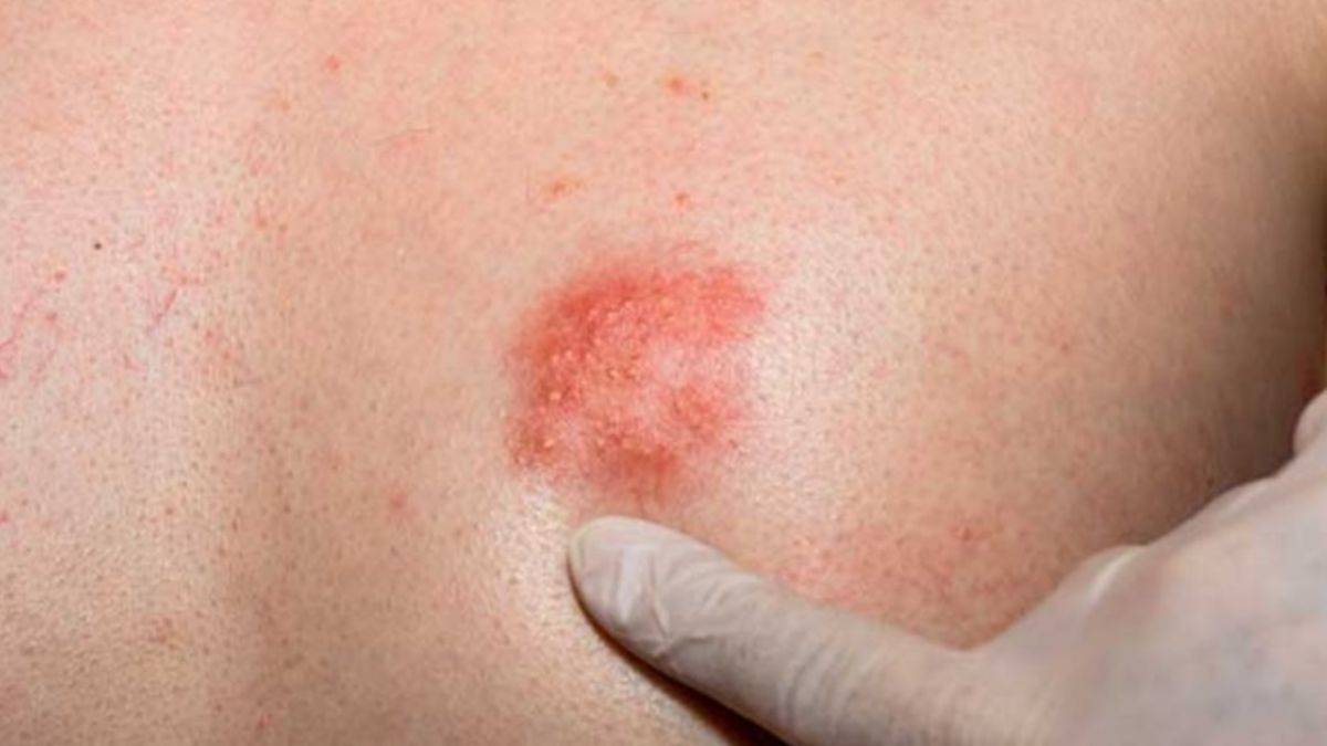 Zona hastalığı neden oluyor?