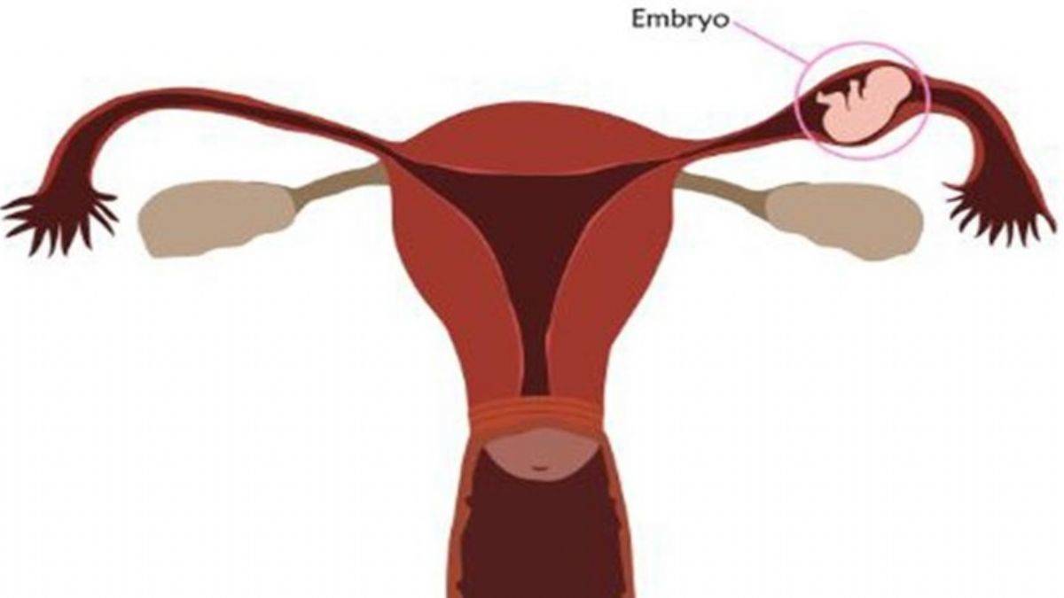 Dış gebelik nedir?