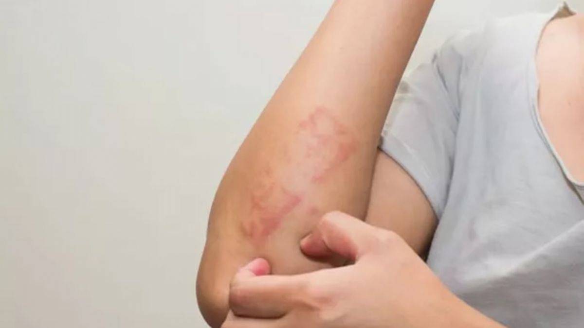 Uyuz nasıl bulaşır?