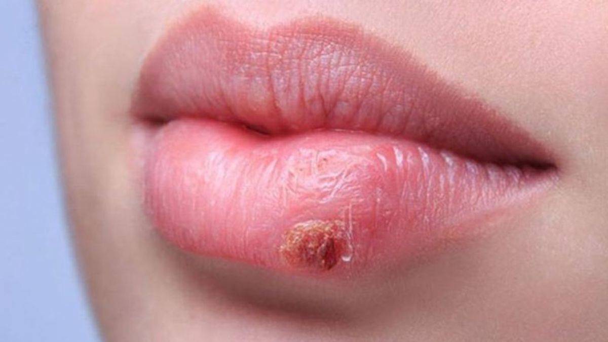 Neden uçuk çıkarıyoruz?