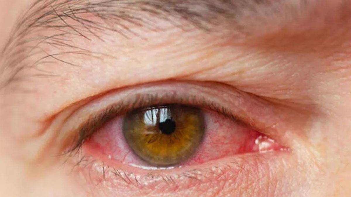 Gözleriniz sık sık kanlanıyorsa o hastalığa sahip olabilirsiniz!