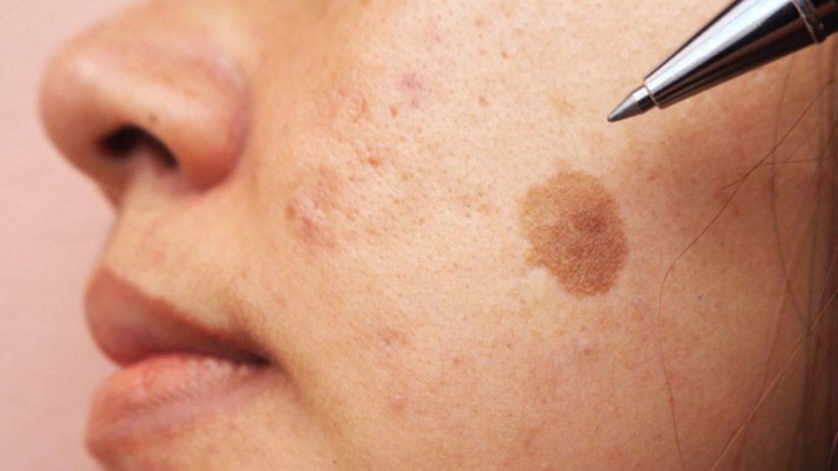 Cildinizde koyu lekeler varsa...