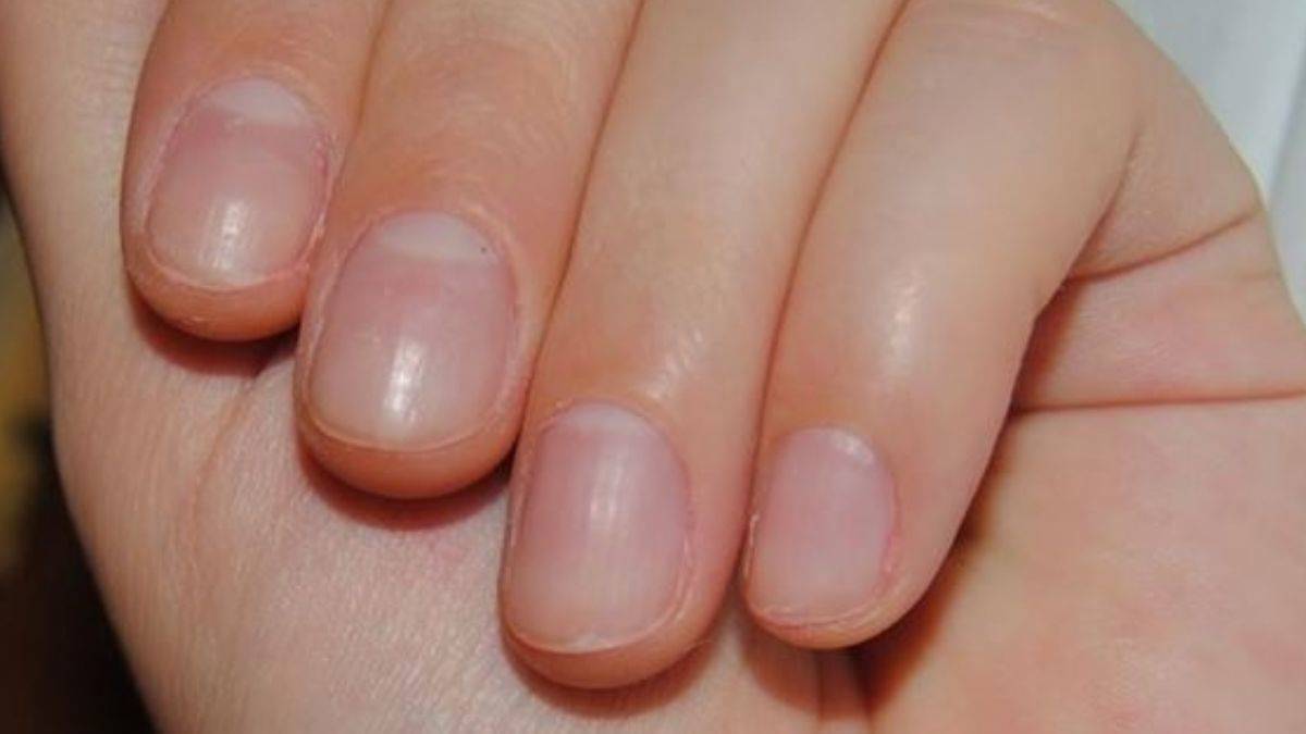 Omicron'un yeni bir belirtisi ortaya çıktı! Tırnakları...