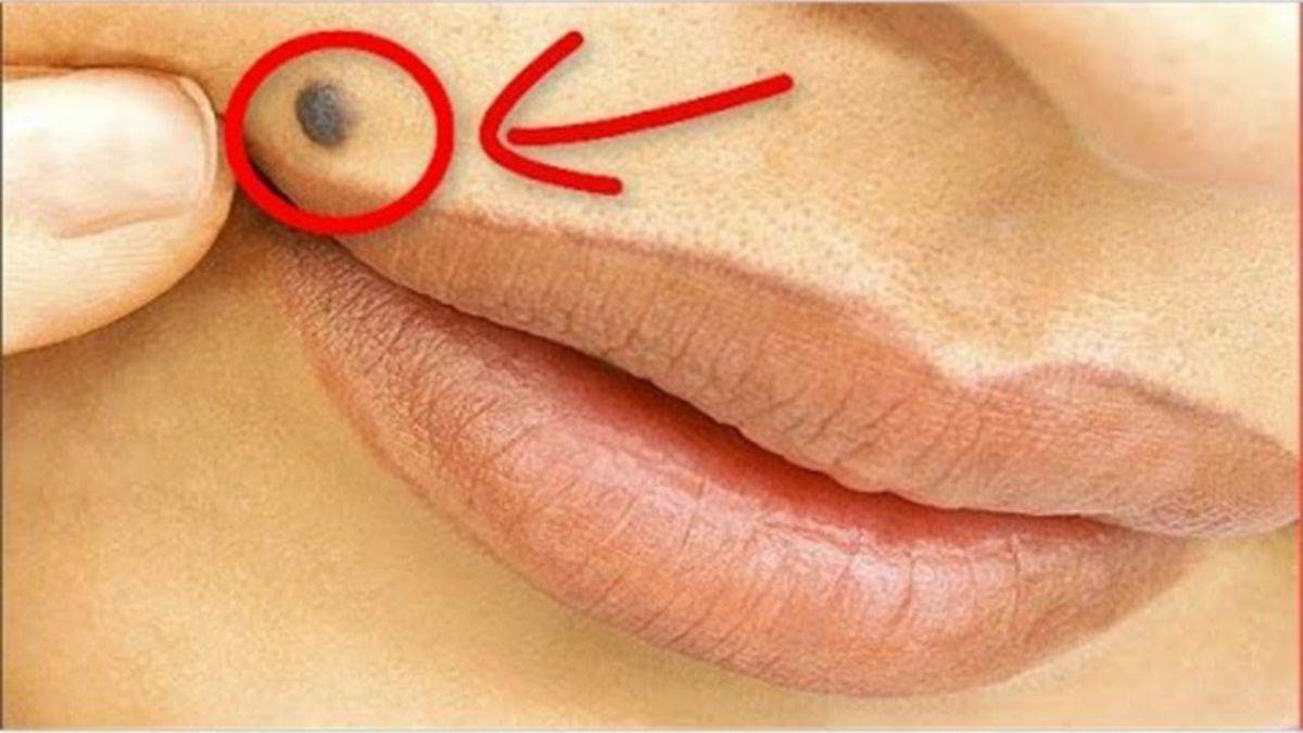 Ben nedir, neden çıkar? I Vucüttaki benlerin anlamı nedir?