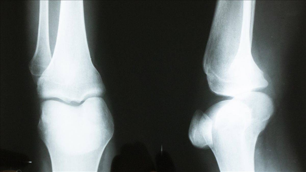 Türkiye’de ilk! Kemik yaşı yapay zeka ile tespit edilecek