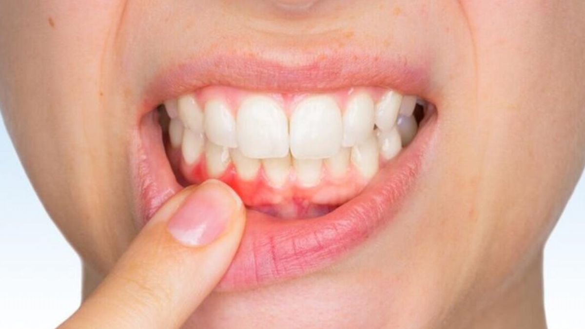 Diş eti kanaması nasıl durdurulur? Tuz gargarası diş kanamasını durdurur mu? Evde diş kanaması durdurma yöntemi