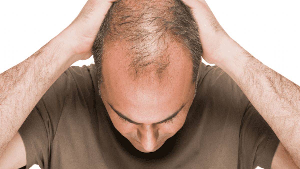 'Kök hücre yöntemi saç dökülmesini durduruyor'