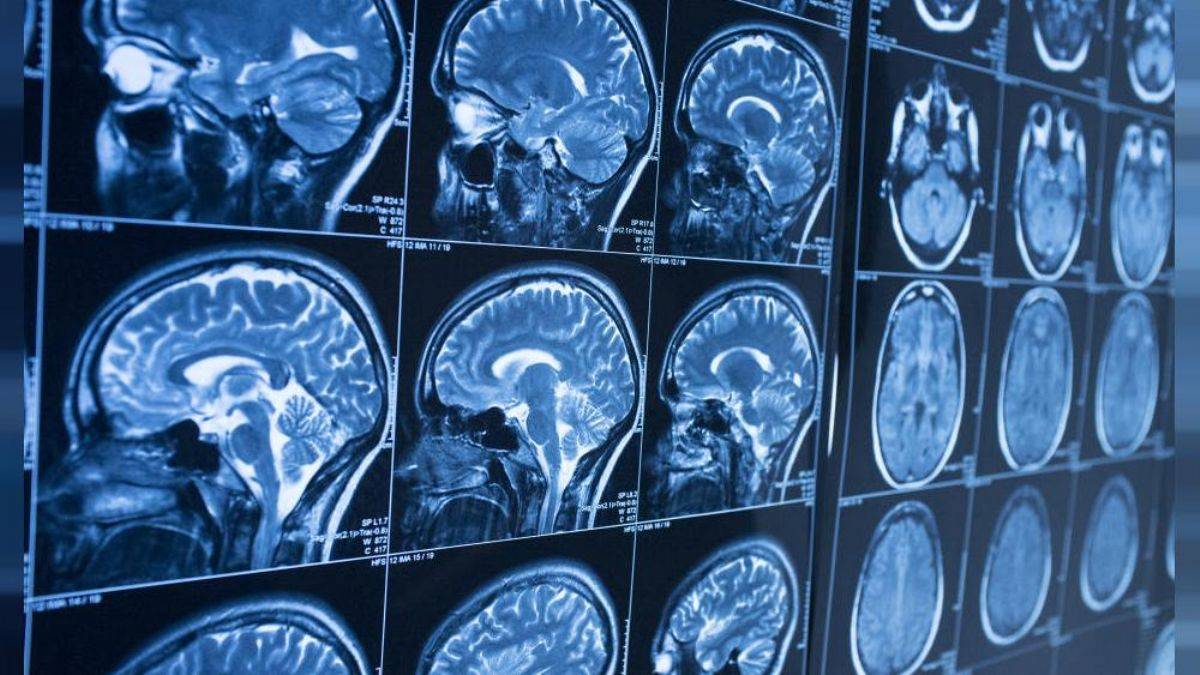 Araştırma: Covid-19 beyinde küçülmeye yol açıyor