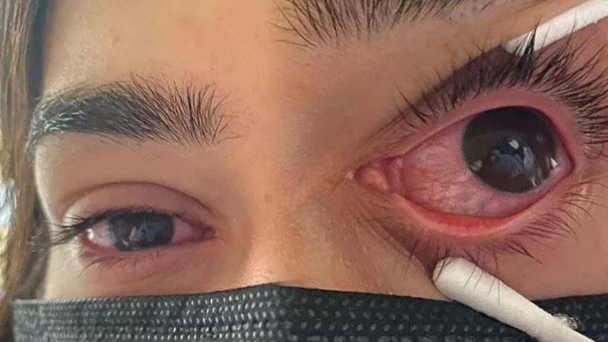 Adenovirüs nedir? Adenovirüs belirtileri nedir? I Adenovirüs'ten korunmanın yolları nelerdir?