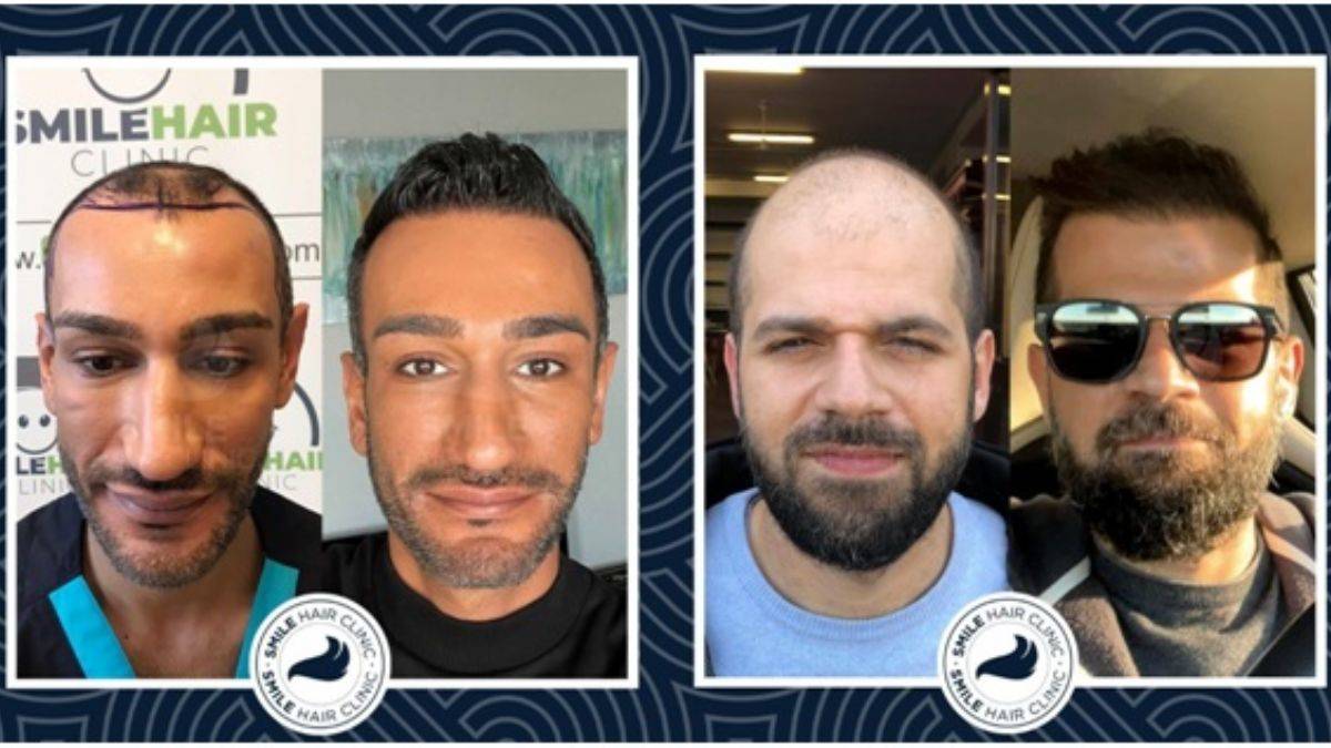 Saç Kökü Nedir? Smile Hair Clinic