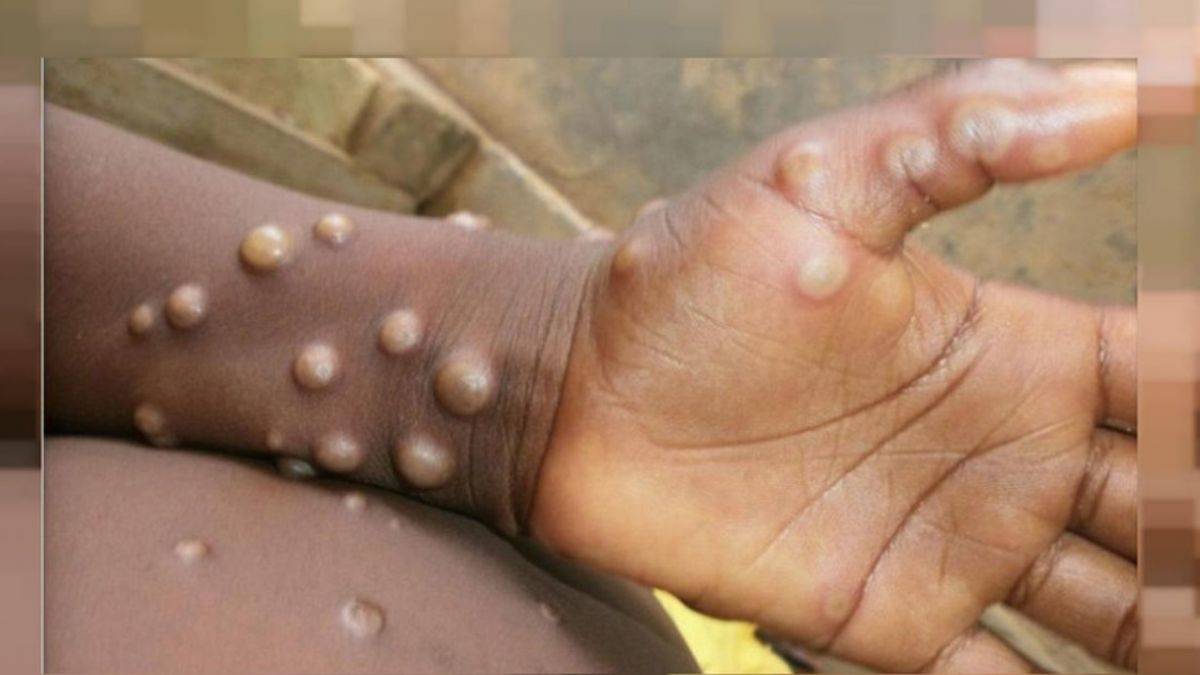 Maymun çiçeği virüsü bir ülkeye daha sıçradı