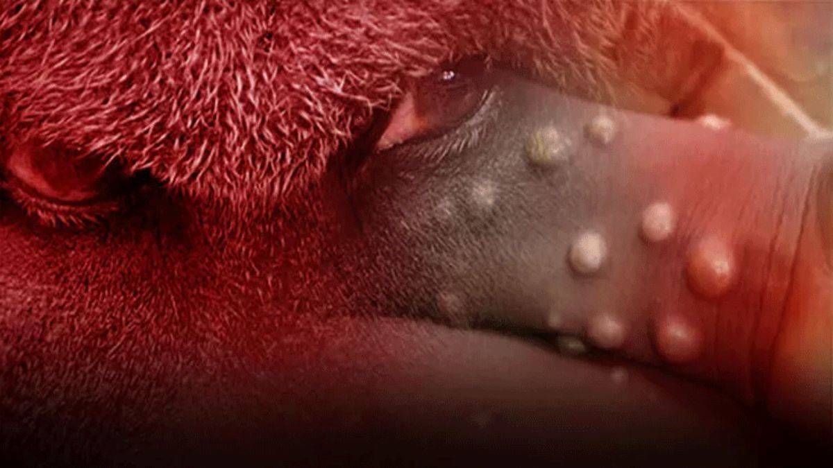 Maymun çiçeği virüsü bir ülkeye daha sıçradı