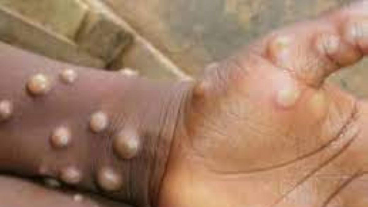 DSÖ, maymun çiçeği vakalarının 257'ye yükseldiğini açıkladı