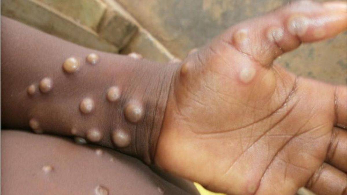 Maymun çiçeği hızla yayılıyor! Bir ülkeye daha sıçradı