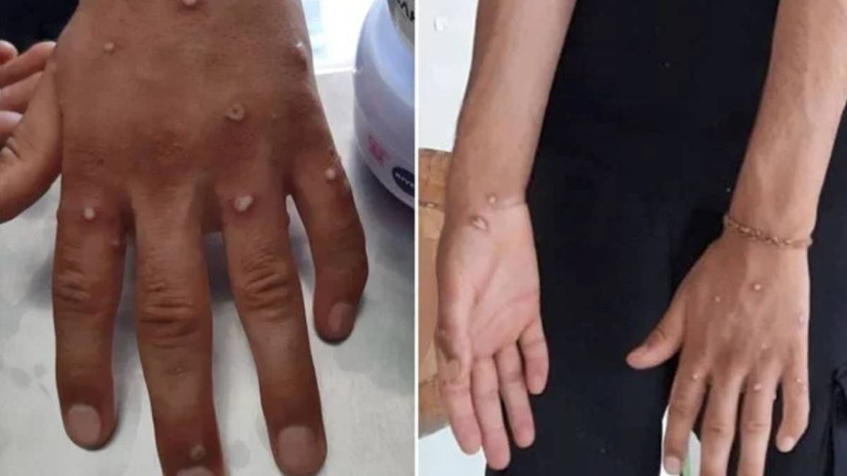 İstanbul'da maymun çiçeği testi yapılan 4 kişinin sonuçları çıktı