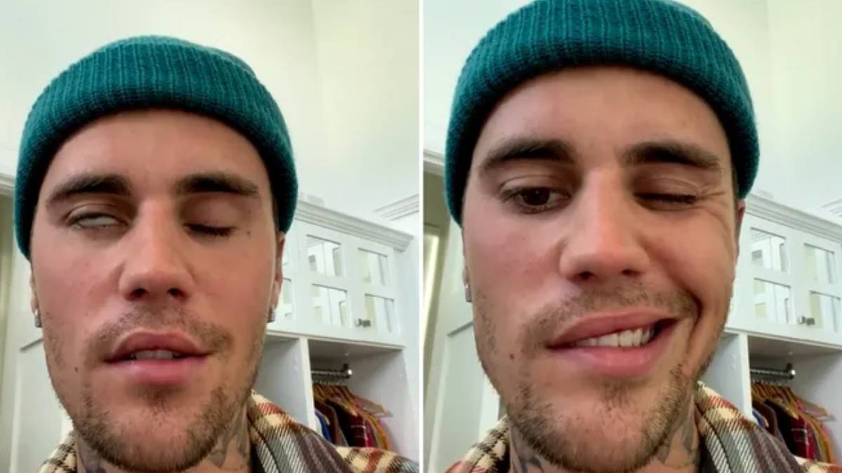 Justin Bieber'in yüzüne ne oldu? Justin Bieber felç mi geçirdi? Ramsay Hunt sendromu nedir? Justin Bieber iyileşti mi?