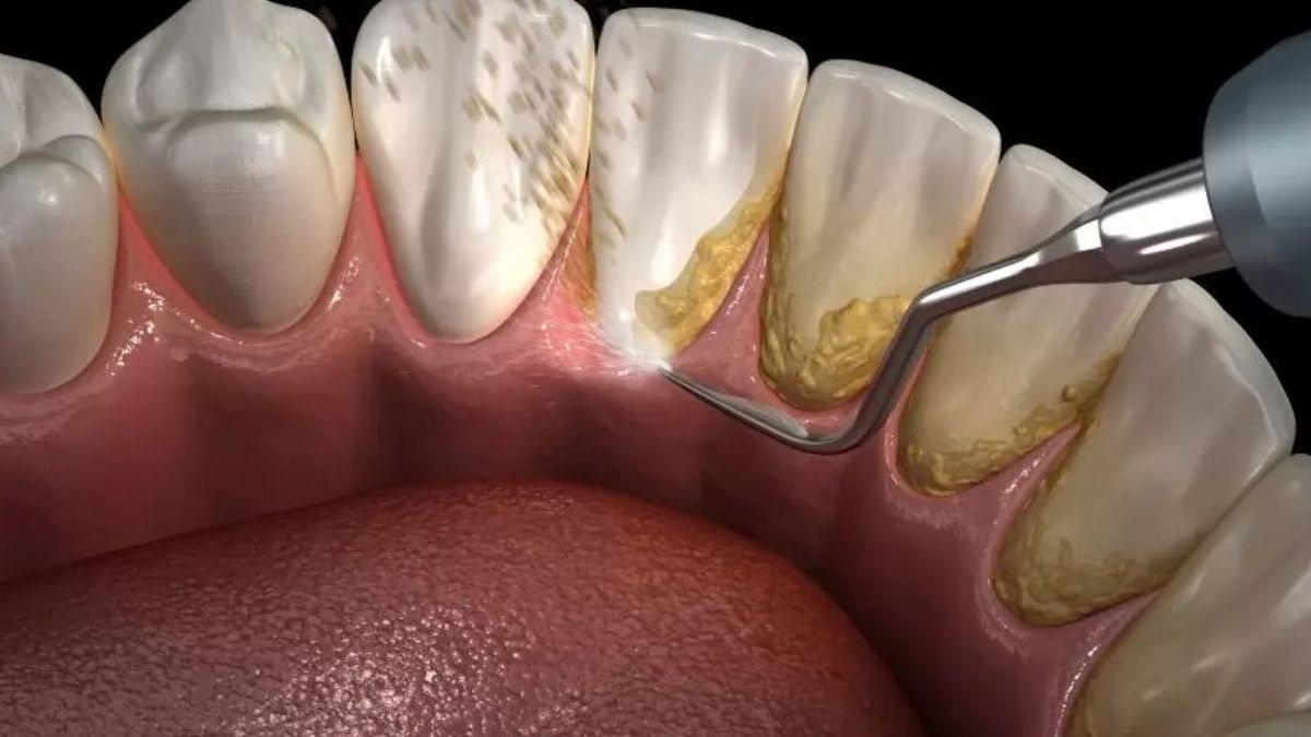 Doğal yollarla diş taşı nasıl temizlenir? Diş taşı nasıl geçer? Diş taşı neden olur? Diş fırçasıyla diş taşı temizlenir mi?