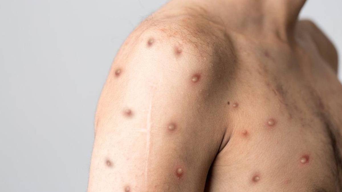 Maymun çiçeği virüsü hangi ilde görüldü? Maymun çiçeği vakası hangi ilde çıktı? Hangi ilde maymun çiçeği virüsü vakası var?