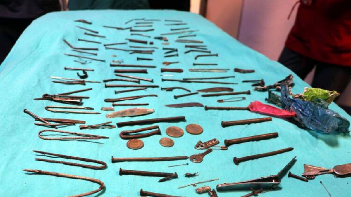 Tam 158 parça metal! Hepsi midesinden çıkarıldı