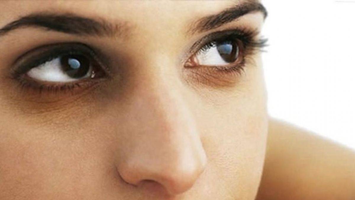 Göz altı morluğu nasıl geçer? Ne iyi gelir?