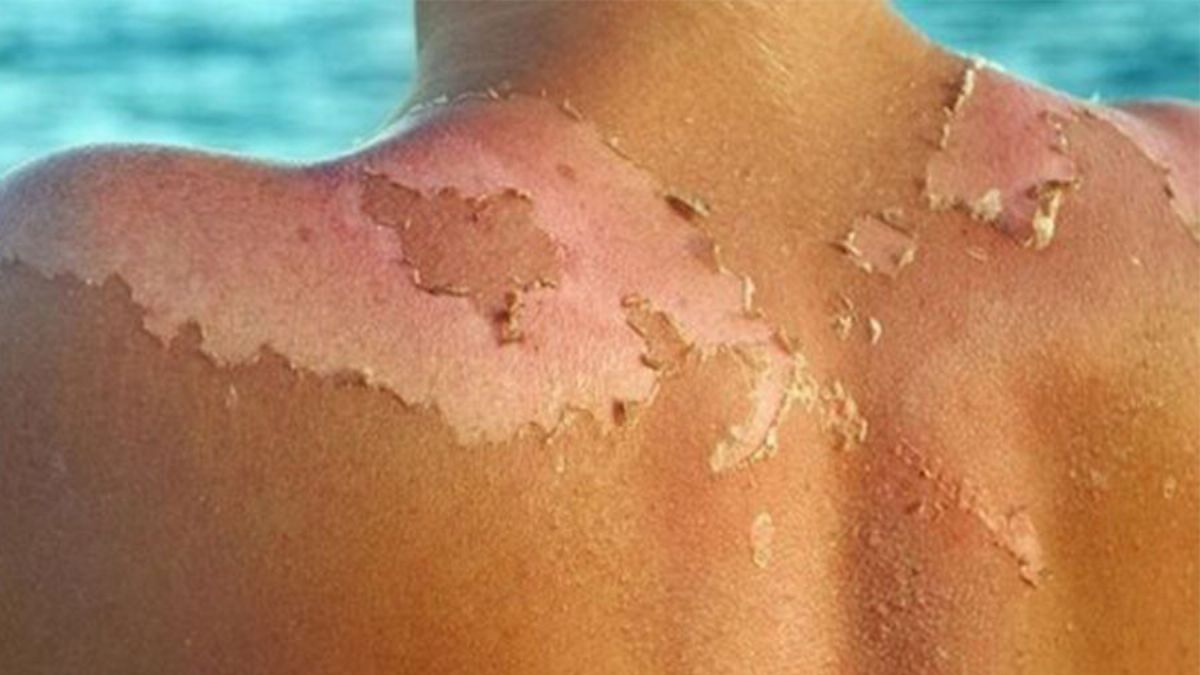 Güneş yanığına ne iyi gelir? Güneşten nasıl korunurum?