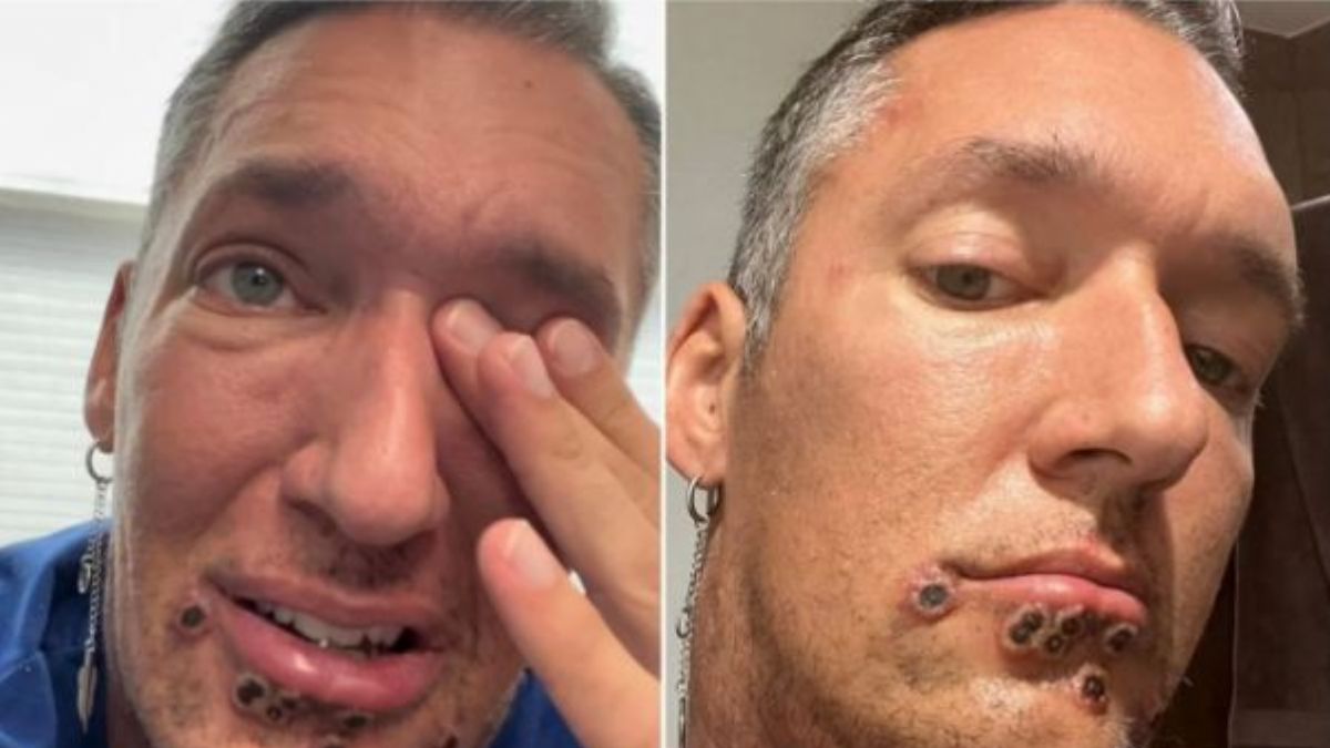 Maymun çiçeği bulaşan adam anlattı | Maymun çiçeği virüsü belirtileri ve hastalık evresi