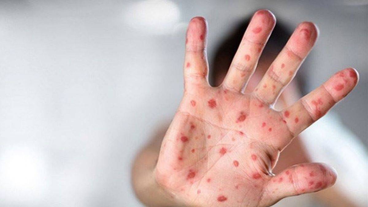 Almanya'da maymun çiçeği paniği! 4 yaşındaki çocuğa bulaştı