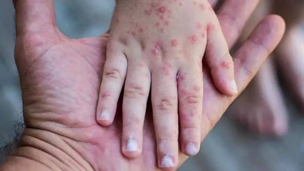 Maymunlar öldürülüyordu! Maymun çiçeği hastalığının adı değişiyor