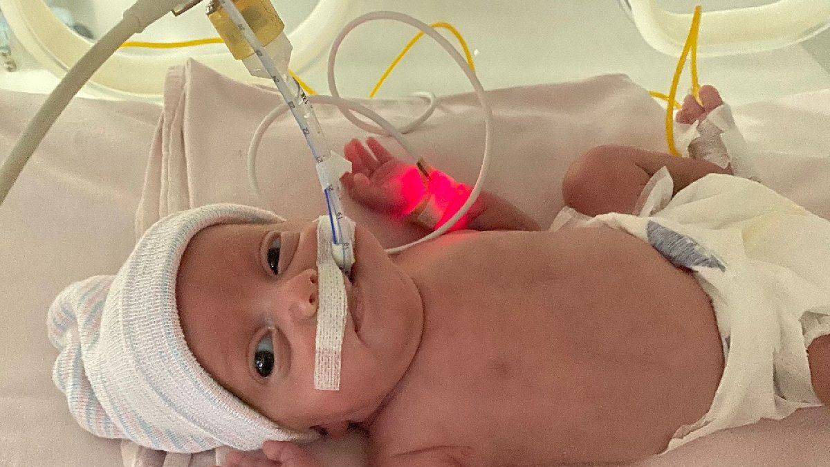 540 gramlık parmak bebek, kök hücre ile hayata tutundu