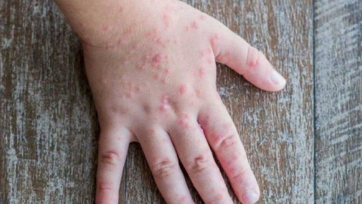 Domates Gribi nedir? Domates Gribi ölümcül mü? Belirtileri, tedavisi nedir?