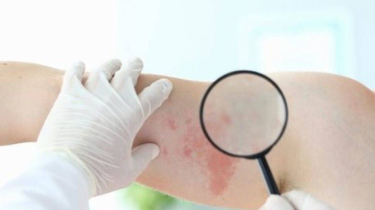 Domates gribi nedir? Domates gribi belirtileri nelerdir?