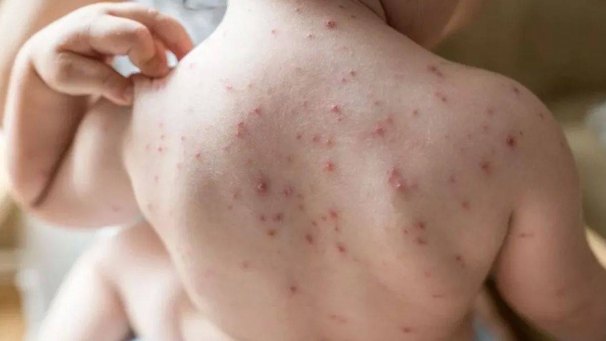 Yeni salgın mı geliyor? Onlarca çocukta 'domates gribi' tespit edildi