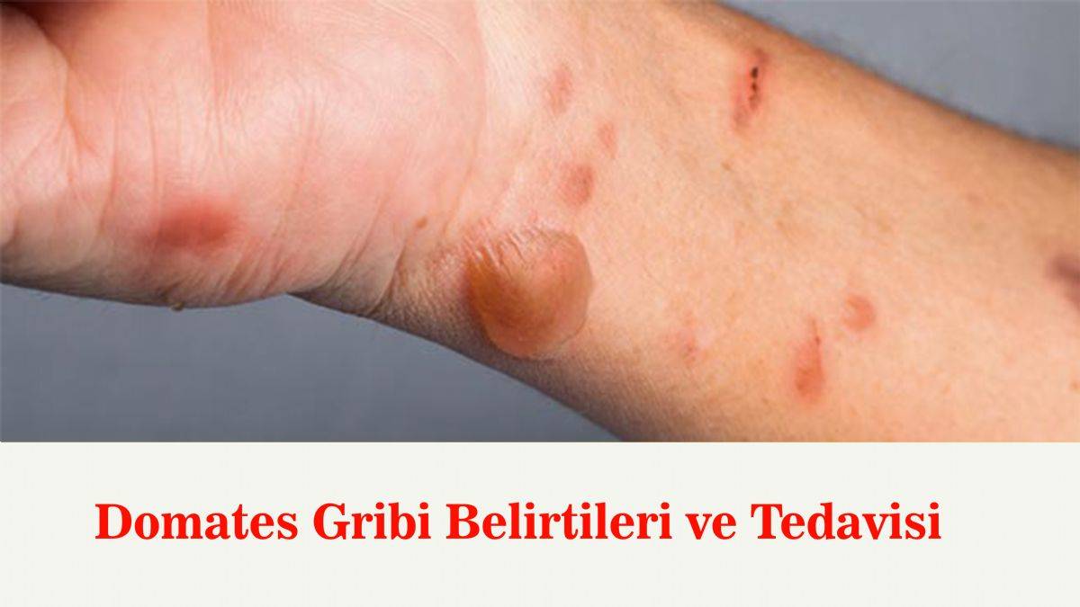 Domates gribi nedir, semptomları nelerdir? Domates gribi nasıl bulaşır? Domates gribi ölümcül mü?